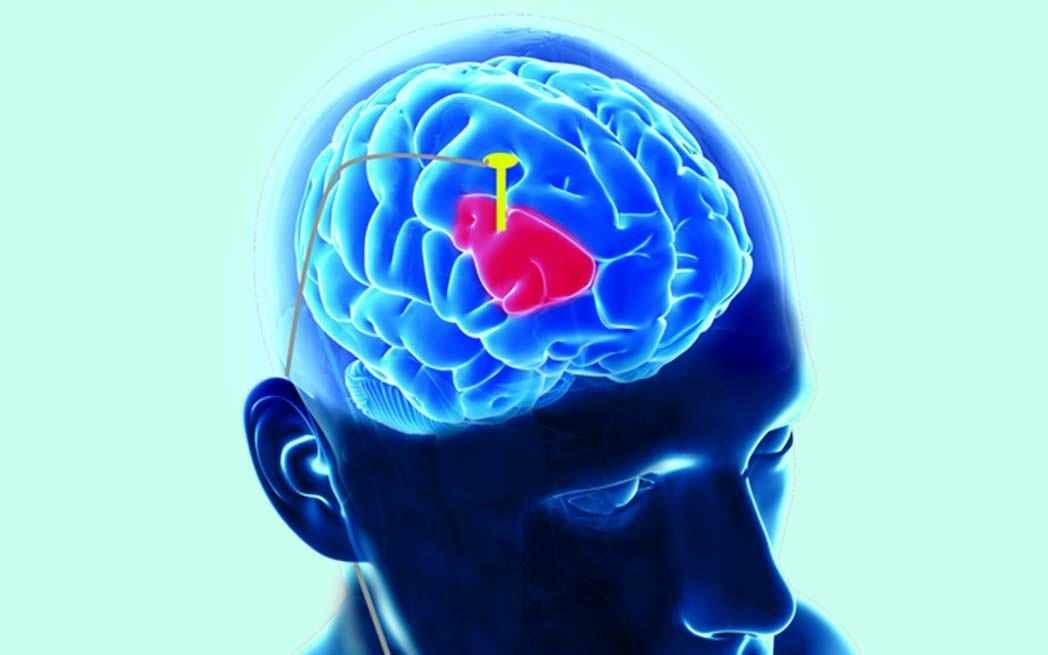 Deep Brain Stimulation - WestmountMag.ca
