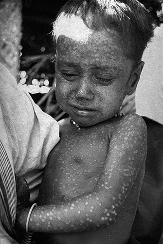 Rahima Banu the last victim of smallpox